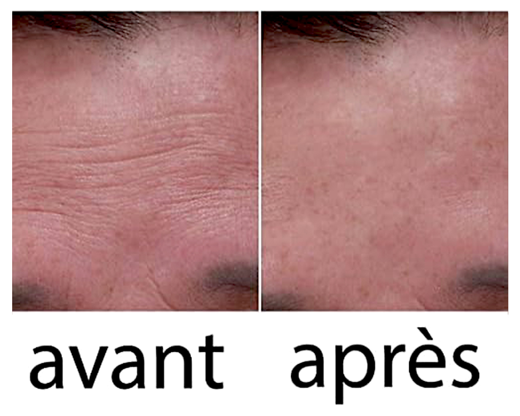 Wrinkle Power : Avis honnêtes sur ce produit anti-rides !